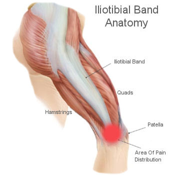 ♾ Iliotibial Band & IT Band Syndrome . IT band syndrome is
