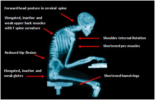 x-ray-of-bad-posture-2 - DeanSomerset.com